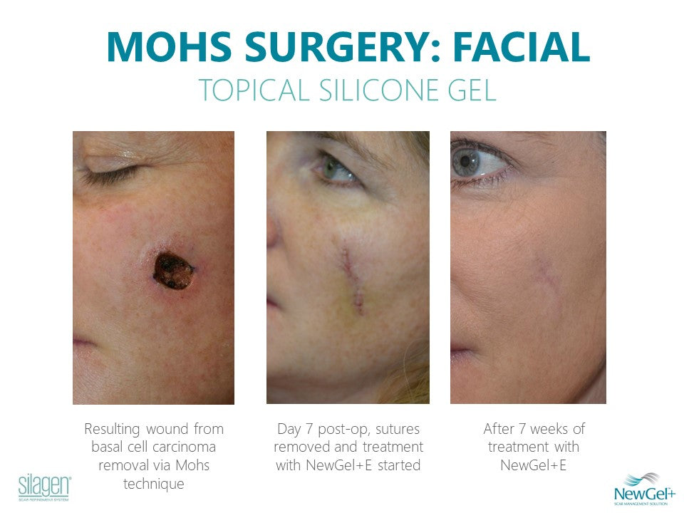 Silagen Scar Gel – 100% Medical-Grade Silicone for Scar Care 15g