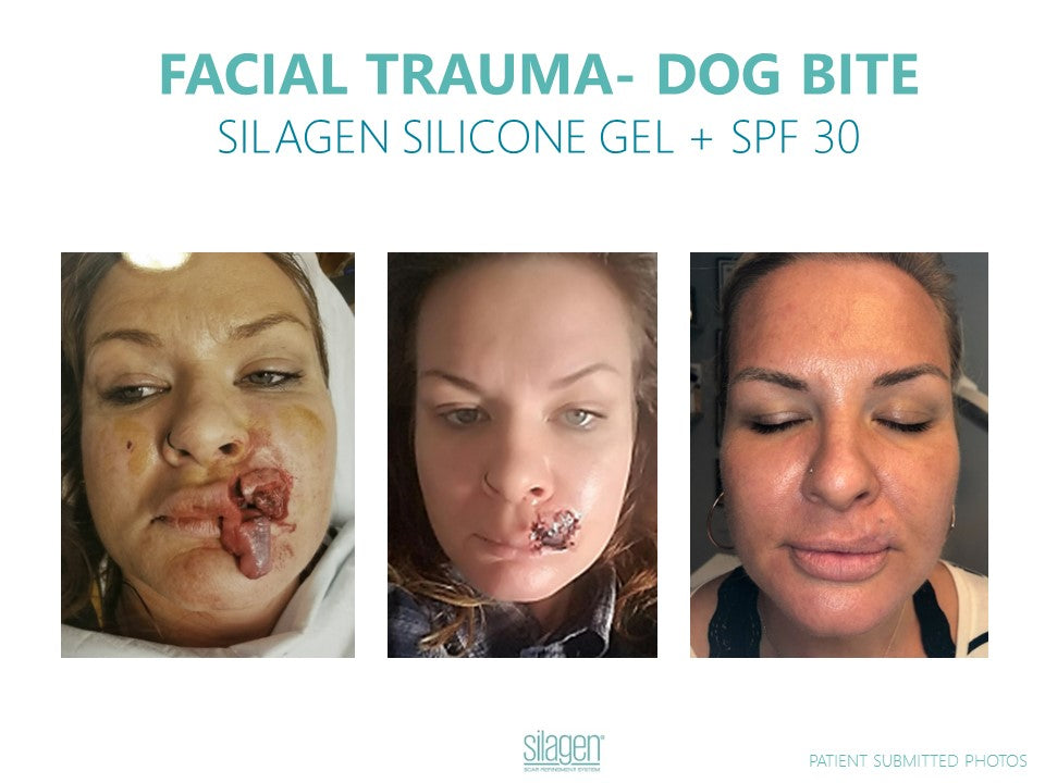 Silagen Scar Gel – 100% Medical-Grade Silicone for Scar Care 15g