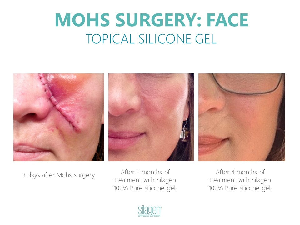 Silagen 100% Pure Gel Silicone For Scar