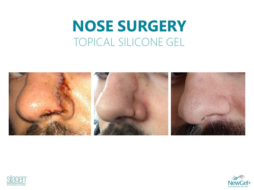 Silagen 100% Pure Gel Silicone For Scar