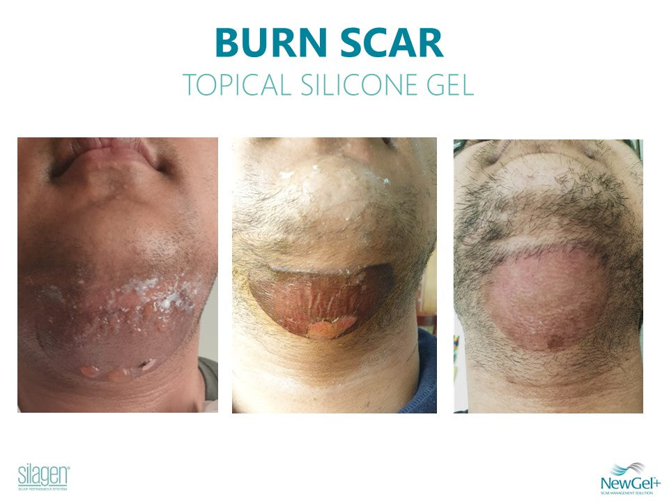 Silagen 100% Pure Gel Silicone For Scar