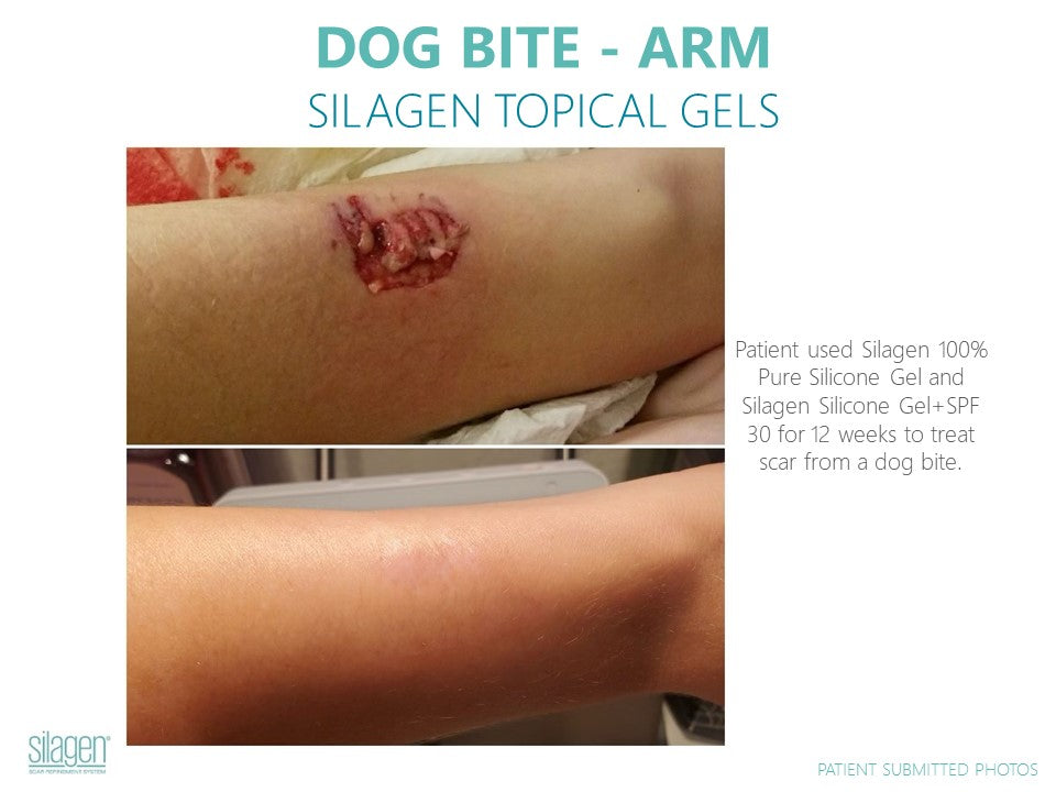 Silagen 100% Pure Gel Silicone For Scar