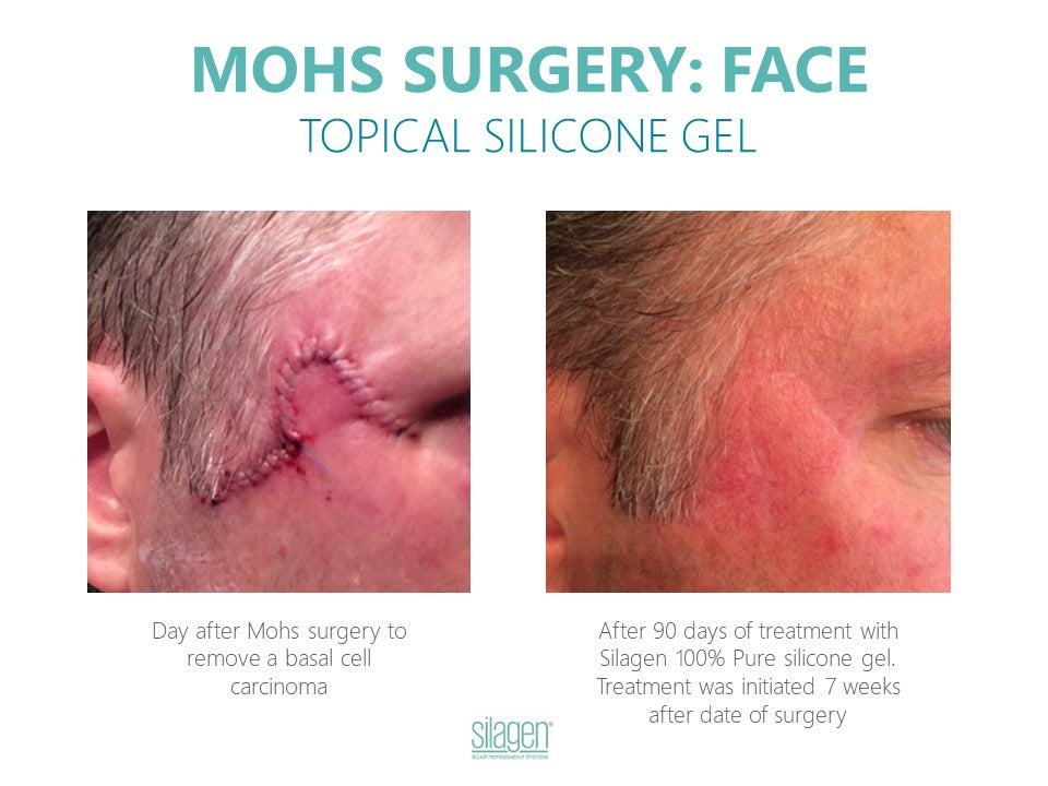 Silagen 100% Pure Gel Silicone For Scar