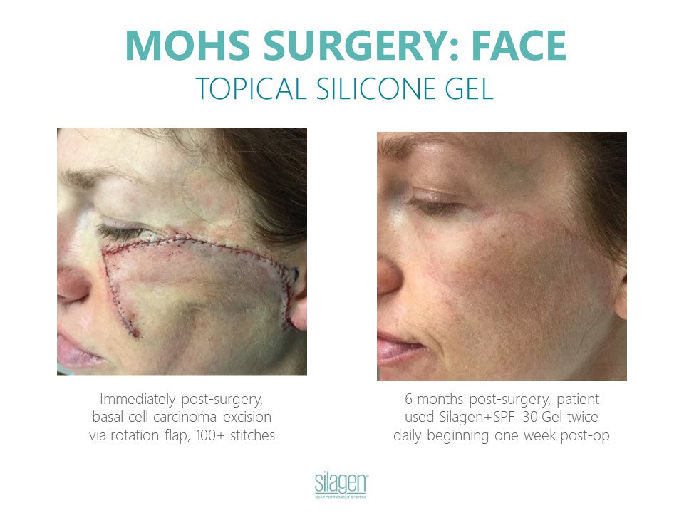 Silagen 100% Pure Gel Silicone For Scar