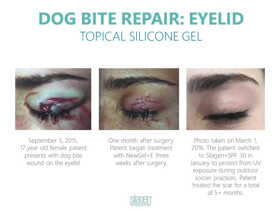 Silagen 100% Pure Gel Silicone For Scar