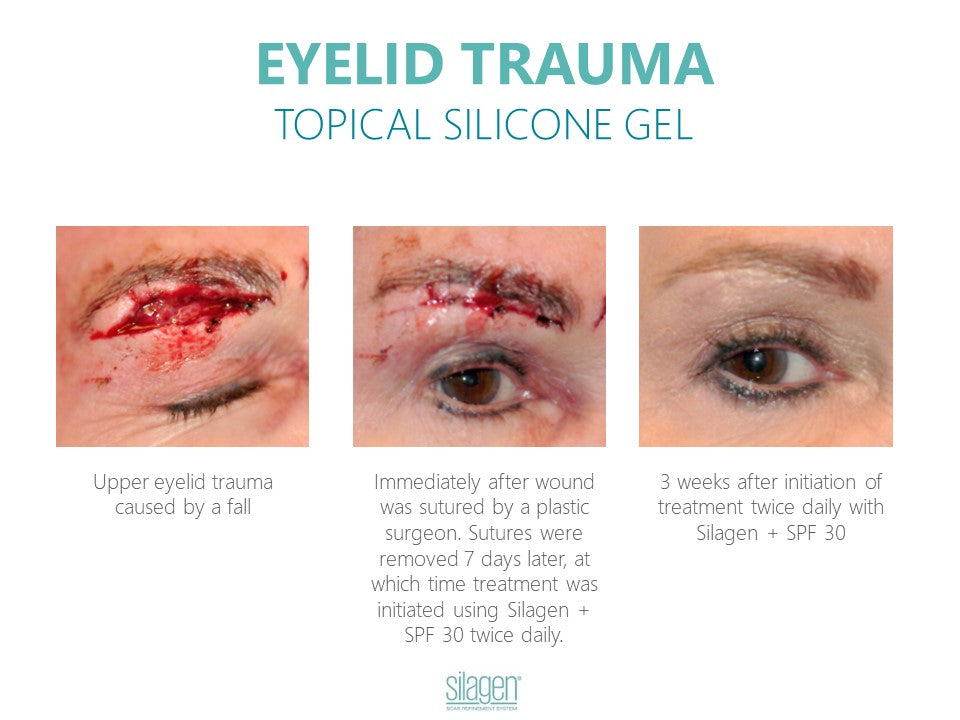 Silagen 100% Pure Gel Silicone For Scar